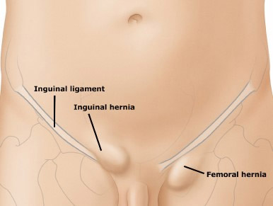 Femoral Hernia (Femorocele) - MR YAHYA AL-HABBAL